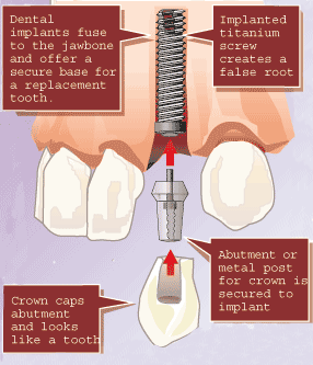 implant-schematic-w-text