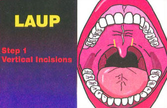 LAUP vertical incisions image