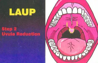Laup Uvula reduction image