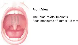 palatal_pillar