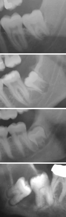 x-rays of impacted teeth